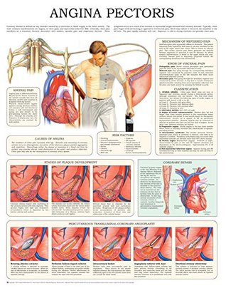 Read Online Angina pectoris e-chart: Quick reference guide - HC-HealthComm file in ePub