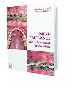 Download Mini-Implants: The Orthodontics of the Future - Skander Ellouze | PDF